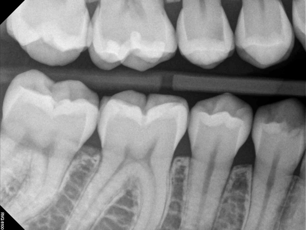 IOPA X-Ray